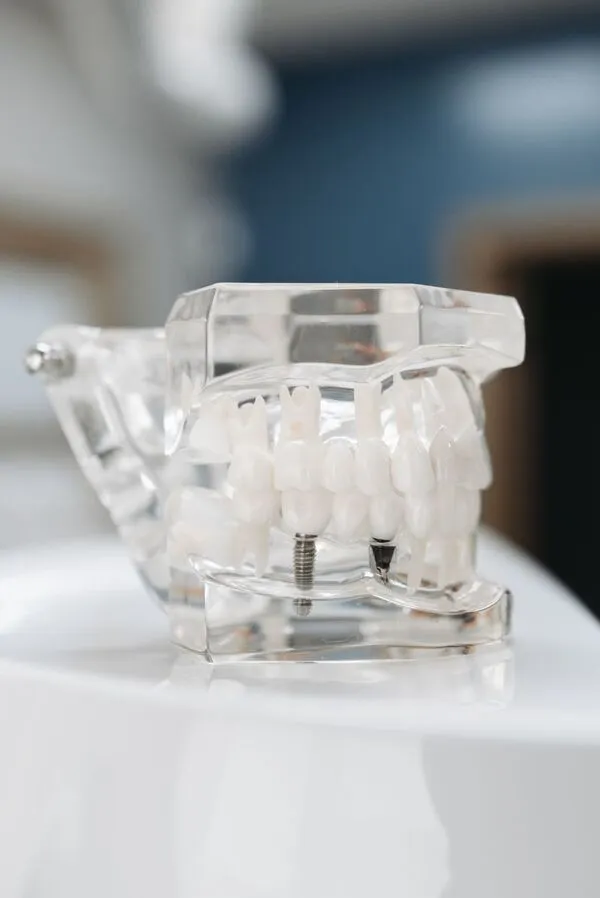 Modelo odontológico transparente mostrando estrutura de implantes